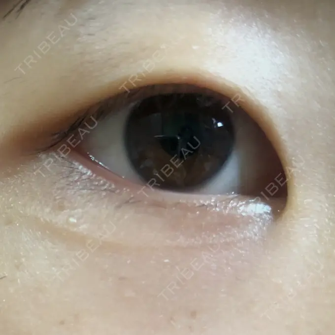 二重埋没 湘南美容クリニック 京都院 BEFORE メイン用