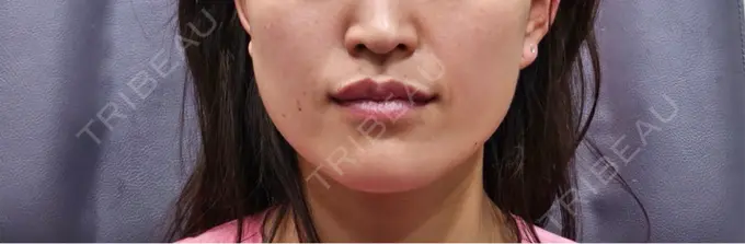 糸リフト / ボトックス（エラ・小顔） VSラインクリニック-江南店 BEFORE メイン用