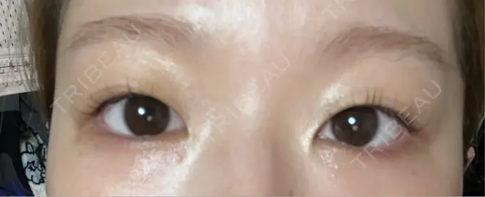 二重埋没 水の森美容クリニック 東京銀座院 BEFORE メイン用