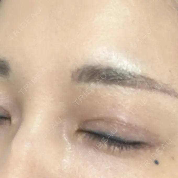 その他（肌） / リジュラン 東京ココセランクリニック BEFORE メイン用