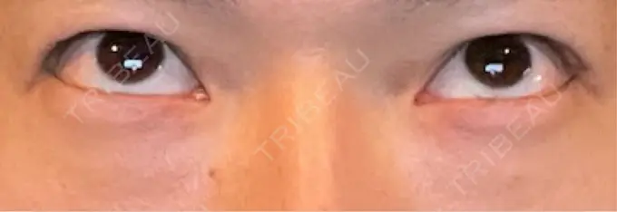 クマ治療 ROOTS Clinic BEFORE メイン用