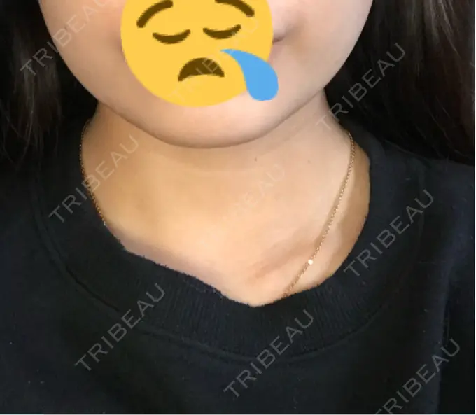 ヒアルロン酸注入（あご） 品川美容外科 名古屋院 BEFORE メイン用