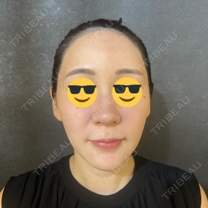 ニードルRF（ポテンツァなど） / ポテンツァ Tokyo Tensei Clinic 銀座院 BEFORE メイン用