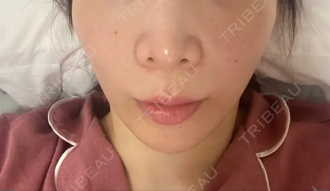 糸リフト / 脂肪吸引（顔） / ボトックス（エラ・小顔） RIVER CLINIC（リバークリニック） BEFORE メイン用