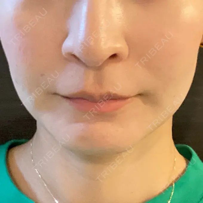 ボトックス（エラ・小顔） / プラセンタ注射 WellnessPlus Clinic 【ウェルネスプラスクリニック】 BEFORE メイン用