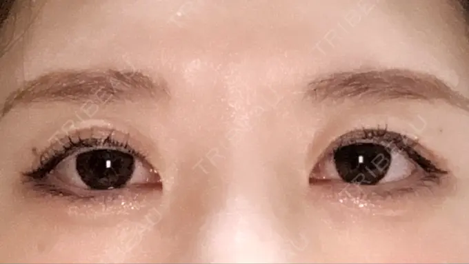 眼瞼下垂（非切開） SOL CLINIC BEFORE メイン用