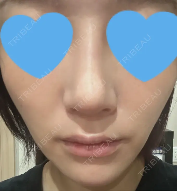 ヒアルロン酸注入（鼻翼基部） DMTC CLINIC 日本橋院 BEFORE メイン用