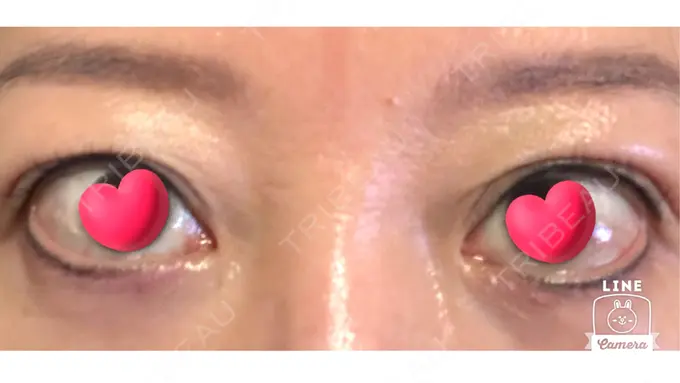 眉下切開 ルーチェクリニック 銀座院 BEFORE メイン用