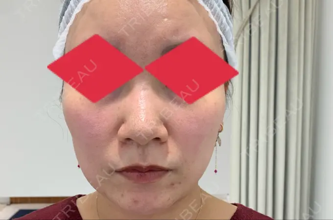 その他（肌） / ルメッカ BIANCA表参道 BEFORE メイン用