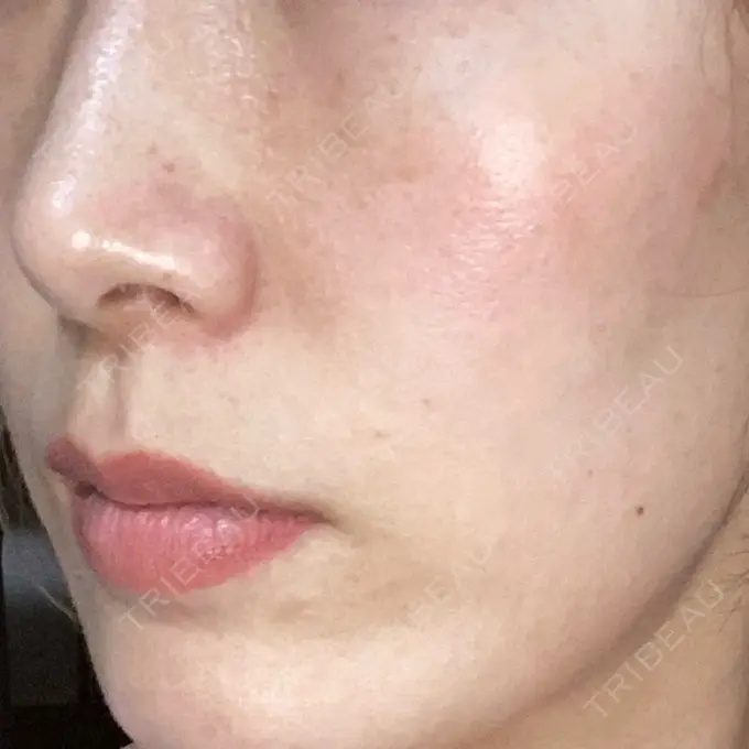 水光注射（ハリ・美肌） オラクル美容皮膚科 名古屋院 BEFORE メイン用