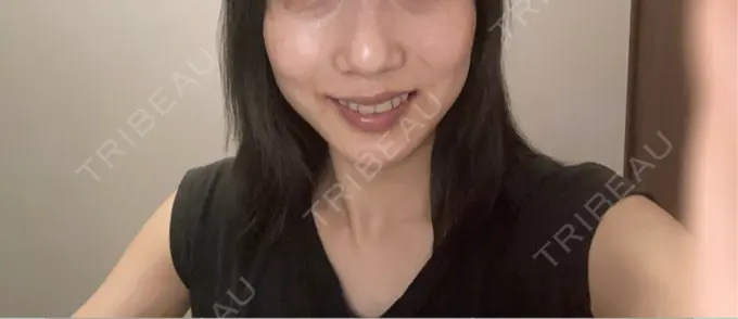 シミ取りレーザー S-Laboクリニック 渋谷院 BEFORE メイン用