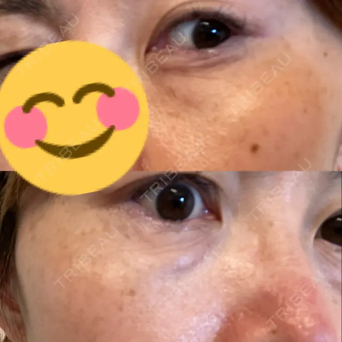 クマ治療 東京形成美容外科 船橋院 BEFORE メイン用