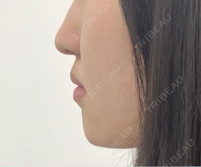 ボトックス（あご） / ボトックス（エラ・小顔） / ボトックス（口角） / ボトックス（人中） / ピーリング（ハリ・ツヤ） 湘南美容クリニック 金山院 BEFORE メイン用