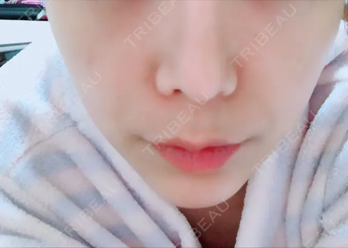 あごプロテーゼ ジュエリー美容外科 BEFORE メイン用