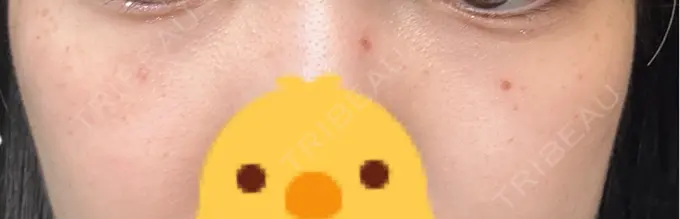 ピコスポット 美容皮膚科エルムクリニック 麻布院 BEFORE メイン用