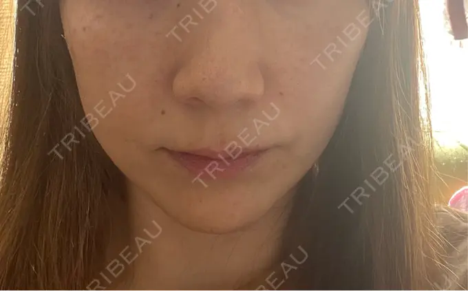 糸リフト / 脂肪吸引（顔） / ボトックス（エラ・小顔） RIVER CLINIC（リバークリニック） BEFORE メイン用