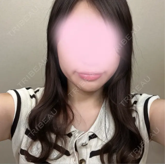 糸リフト / 脂肪吸引（顔） 東京ココセランクリニック BEFORE メイン用