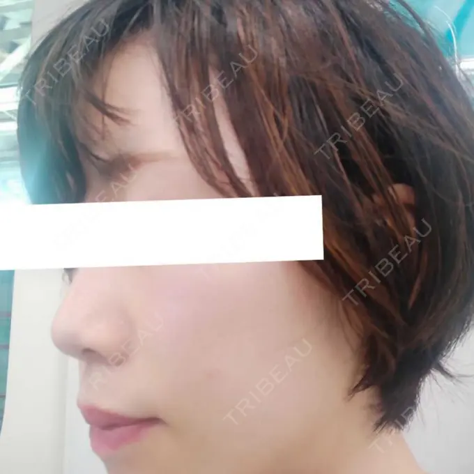 ハイフ（顔） / ハイフ（首） 銀座TSUBAKIクリニック BEFORE メイン用