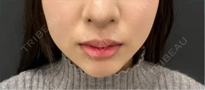 ヒアルロン酸注入（鼻翼基部） ルラ美容クリニック 広島院 BEFORE メイン用