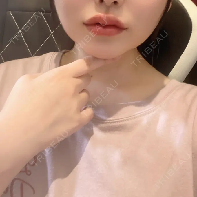 ヒアルロン酸注入（唇） / ボトックス（人中） ROOTS Clinic BEFORE メイン用