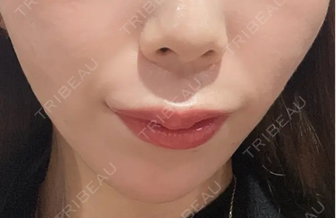 糸リフト / 人中短縮 / ジョールファット除去 吉祥寺アイビークリニック BEFORE メイン用