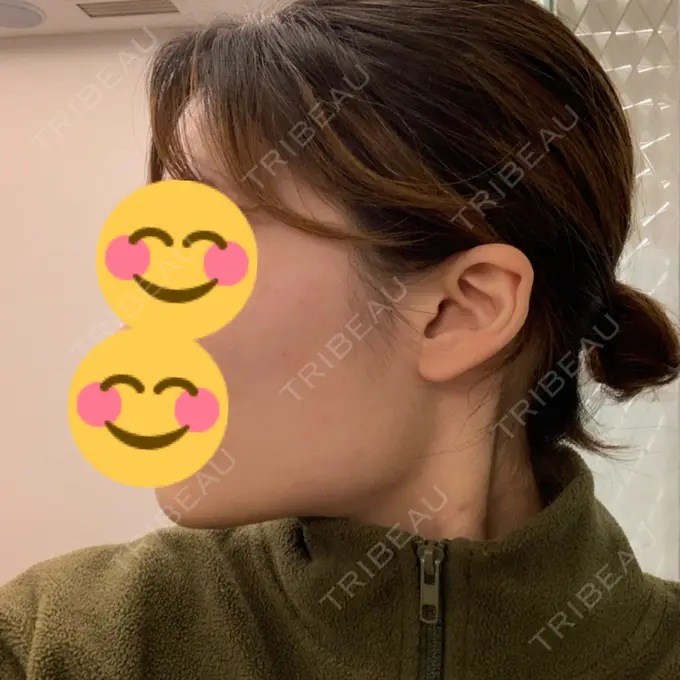 骨切り（あご） / 骨削り（エラ） / 骨削り（頬） id（アイディ）美容外科 BEFORE メイン用