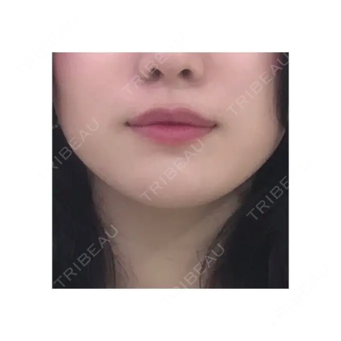 バッカルファット除去 / 脂肪吸引（顔） / ヒアルロン酸注入（鼻） / ボトックス（あご） / 水光注射（ハリ・美肌） / ヒアルロン酸注入（あご） / ボトックス（エラ・小顔） / 白玉点滴・注射 エートップ美容整形外科 BEFORE メイン用