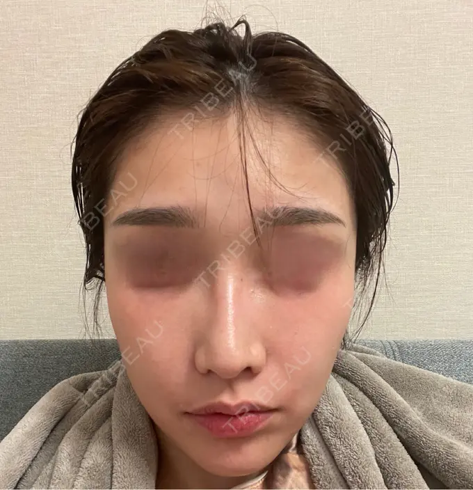 ピコスポット お肌のクリニック　高田馬場 BEFORE メイン用