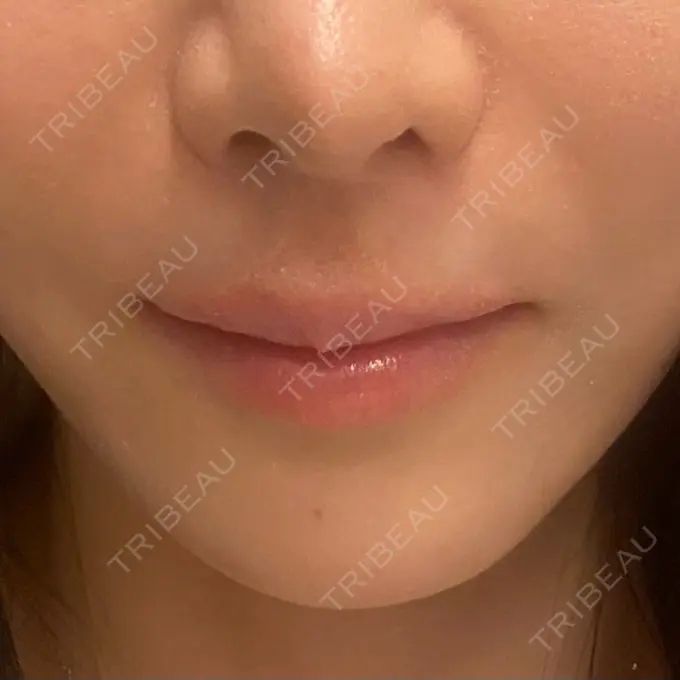 肌ヒアルロン酸注入（たるみ・シワ改善） / ヒアルロン酸注入（唇） BiBiクリニック BEFORE メイン用