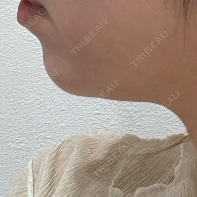 ハイフ（顔） / エレクトロポレーション ちぐさ内科クリニック 覚王山 BEFORE メイン用