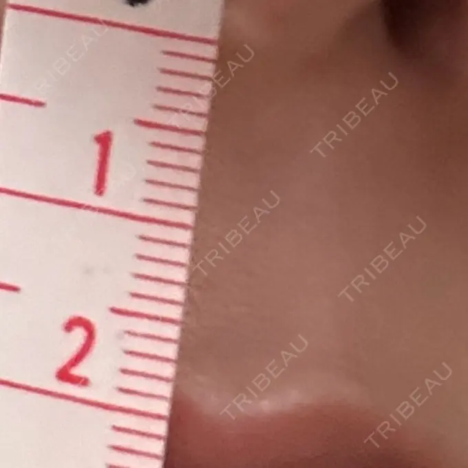 小鼻縮小（切開） / 人中短縮 eクリニック 東京院 BEFORE メイン用