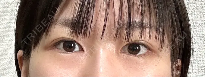 二重埋没 THE FIRST CLINIC 多摩センター院 BEFORE メイン用