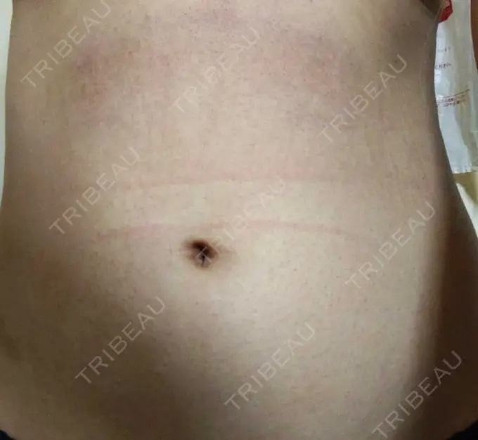 脂肪冷却（お腹） DMTC美容皮膚科 大宮院 BEFORE メイン用