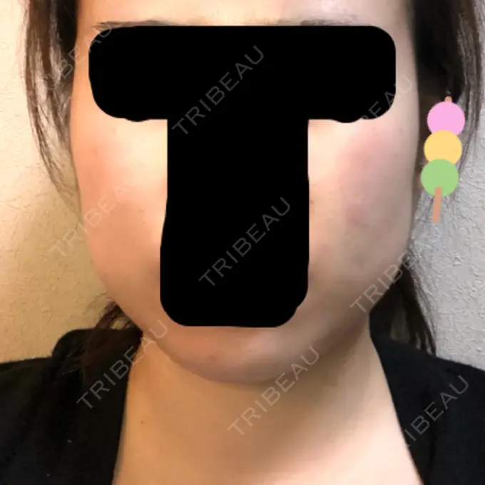 脂肪吸引（顔） フレッシュ整形外科 BEFORE メイン用