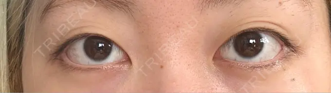 二重埋没 東京ココセランクリニック BEFORE メイン用