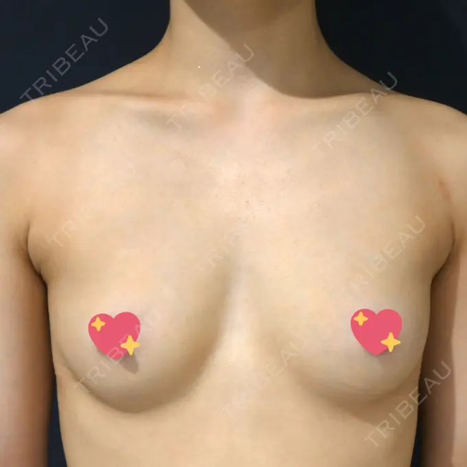 豊胸（脂肪注入） S.T styleクリニック BEFORE メイン用