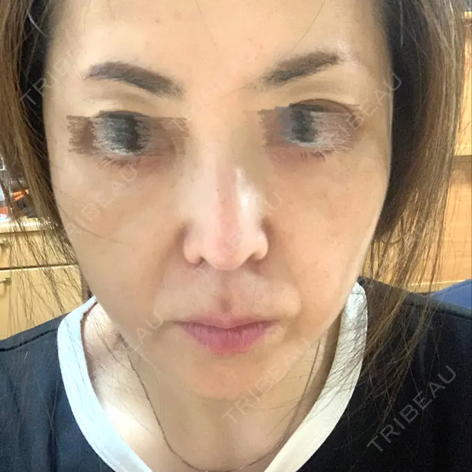 糸リフト / ヒアルロン酸注入（頬） ネビュラクリニック 京都院 BEFORE メイン用