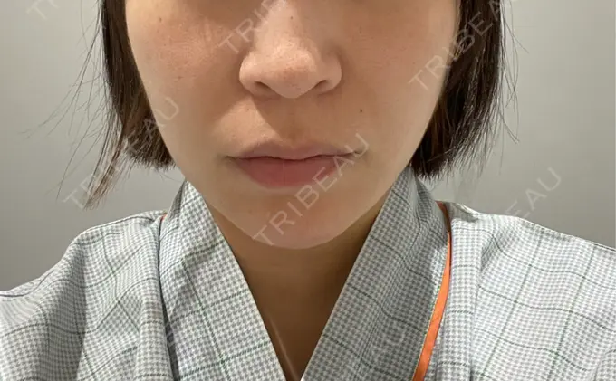 小鼻縮小（切開） / 人中短縮 Otus Clinic 【オータスクリニック】 BEFORE メイン用