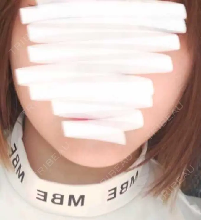 脂肪吸引注射（顔） 東京シンデレラ美容外科 池袋院 BEFORE メイン用