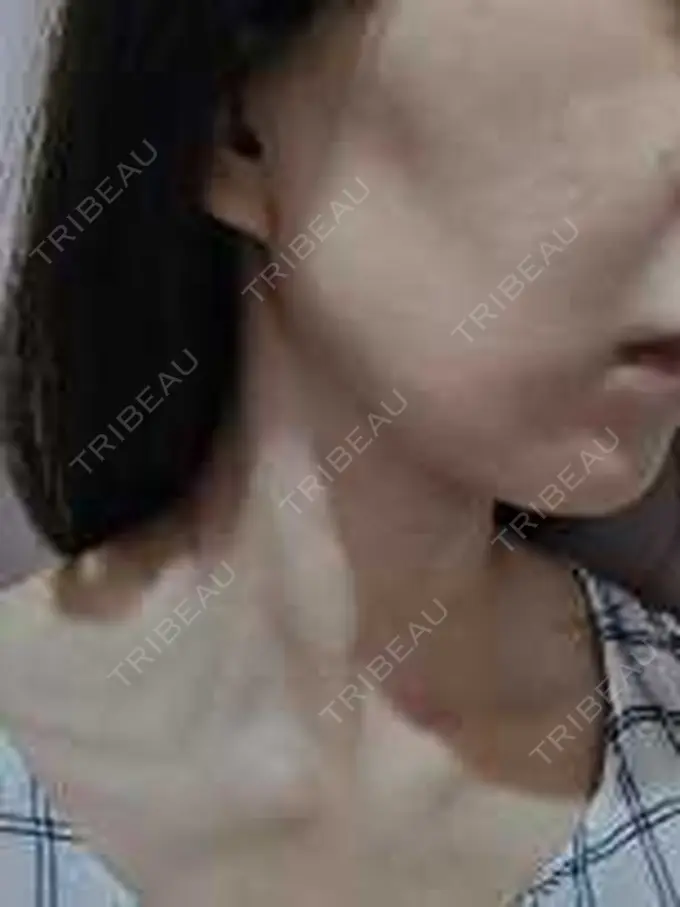 ピーリング（ニキビ・毛穴） 豊洲内科・糖尿病 / 形成・美容外科クリニック BEFORE メイン用