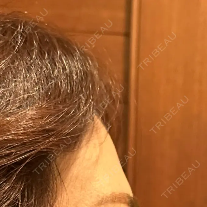 肌ヒアルロン酸注入（たるみ・シワ改善） / ヒアルロン酸注入（額） ROOTS Clinic BEFORE メイン用