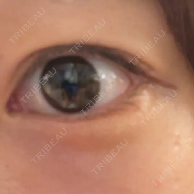 ヒアルロン酸注入（涙袋） フィラークリニック 福岡院 BEFORE メイン用