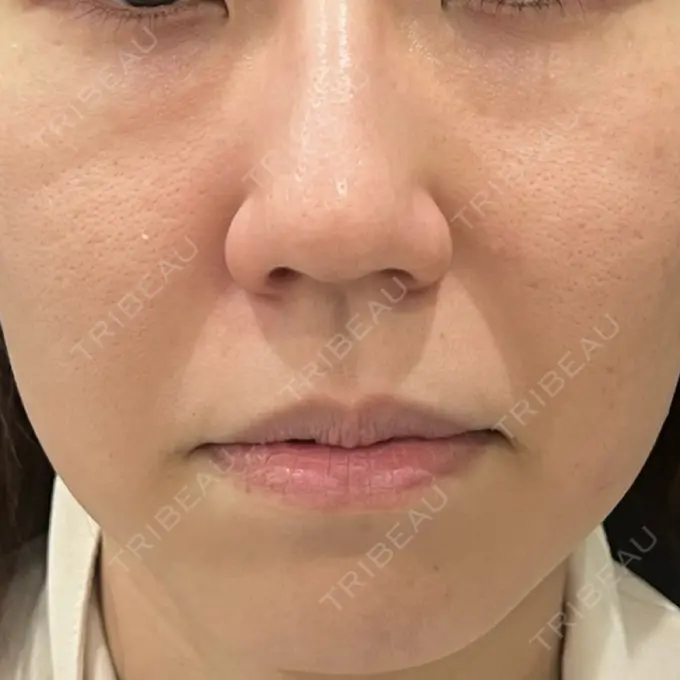 クマ治療 吉井クリニック BEFORE メイン用