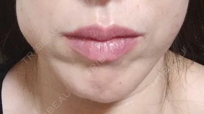 ボトックス（エラ・小顔） TCB東京中央美容外科 金山院 BEFORE メイン用