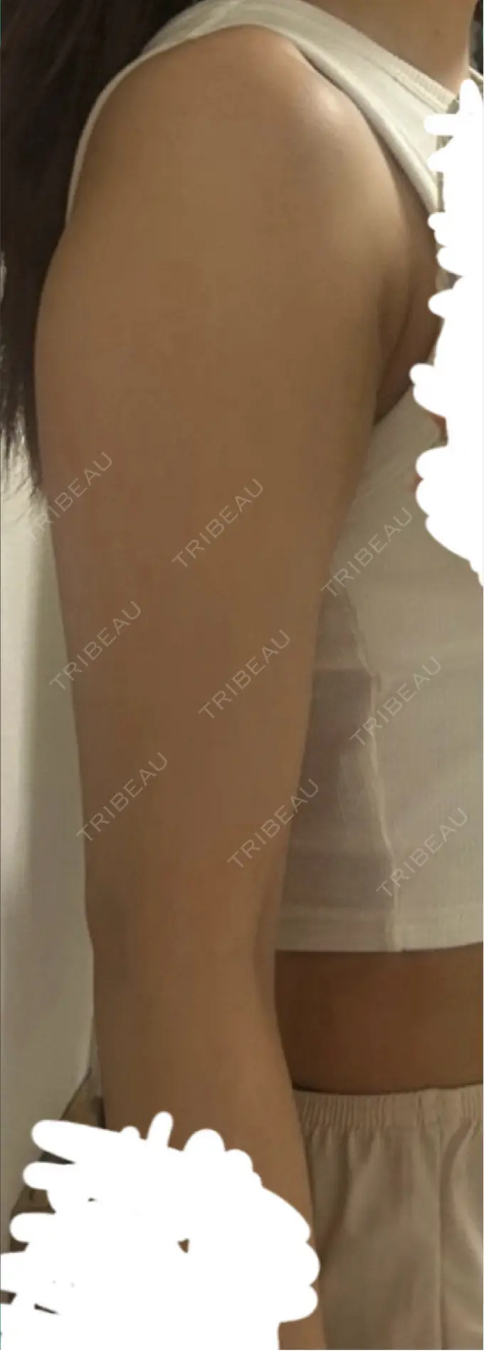 脂肪吸引（二の腕） / 脂肪吸引（肩） / その他（ボディ） ルーチェクリニック 銀座院 BEFORE メイン用