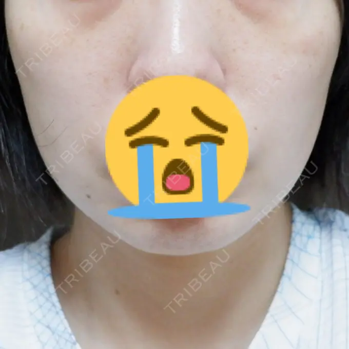 ボトックス（エラ・小顔） TCB東京中央美容外科 つくば院 BEFORE メイン用