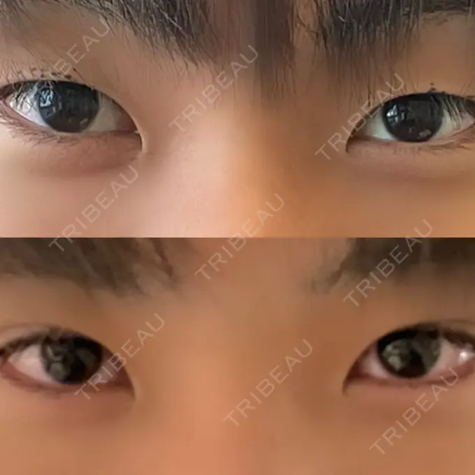 二重埋没 日本ウェルネス再生クリニック BEFORE メイン用