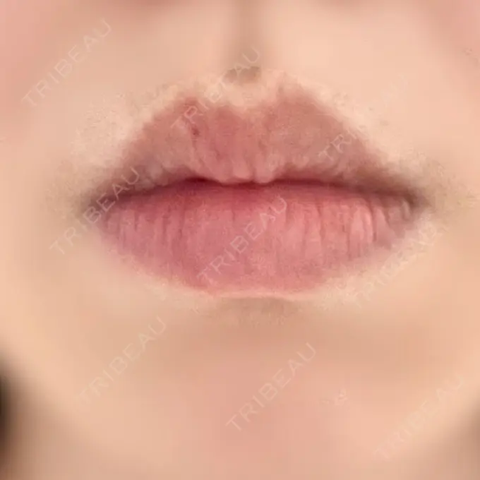 ヒアルロン酸注入（唇） ルラ美容クリニック 名古屋栄院 / ルラスキンクリニック 名古屋栄院 BEFORE メイン用