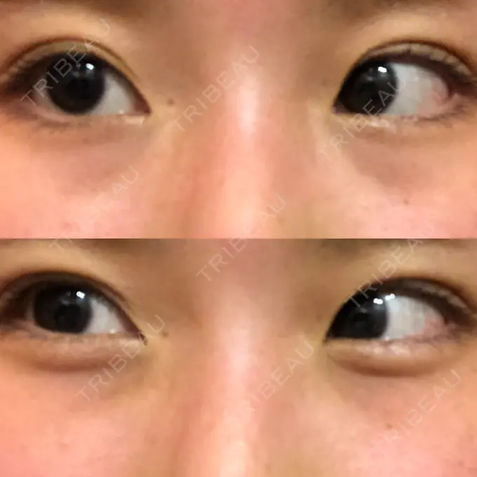 クマ治療 韓国ST美容整形外科 BEFORE メイン用