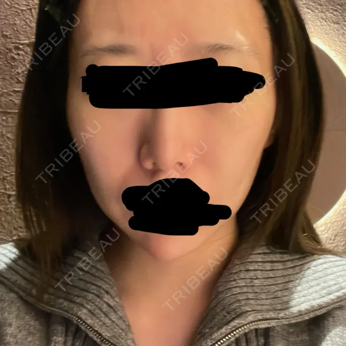 鼻尖形成（切開） / 軟骨移植 / 鼻柱下降・鼻唇角形成（猫手術） eクリニック 金沢本院 BEFORE メイン用